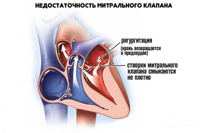 Недостаточность митрального клапана: общая информация