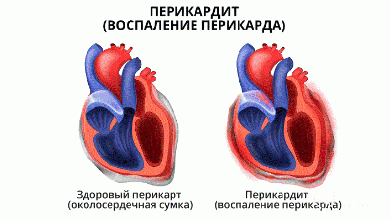 Перикардит: полная информация