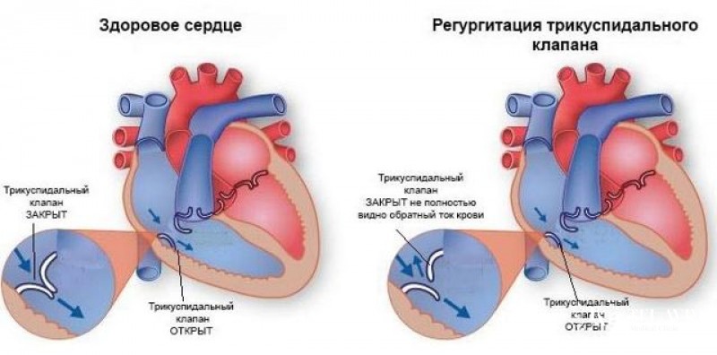 Трикуспидальная недостаточность (ТН): общая информация