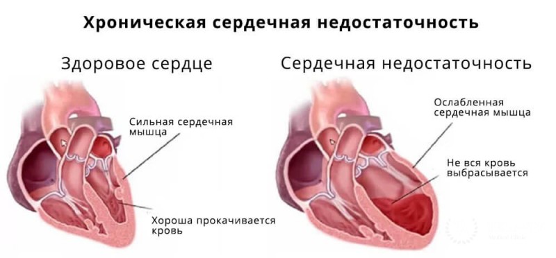 Хроническая сердечная недостаточность: общая информация