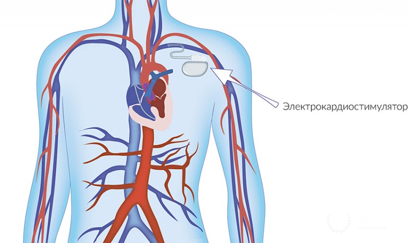 Имплантация электрокардиостимулятора: полное описание