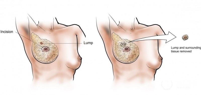 Lumpectomy