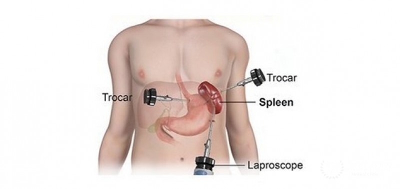 Splenectomy