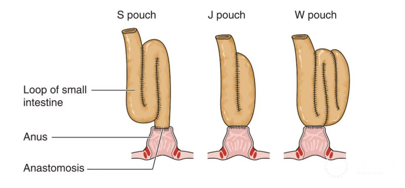 Total proctocolectomy ileal pouch anal anastomosis