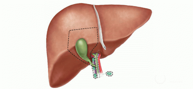 Radical Cholecystectomy