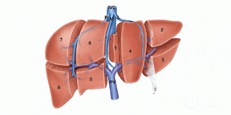 HCC Open Surgery - Liver Resection