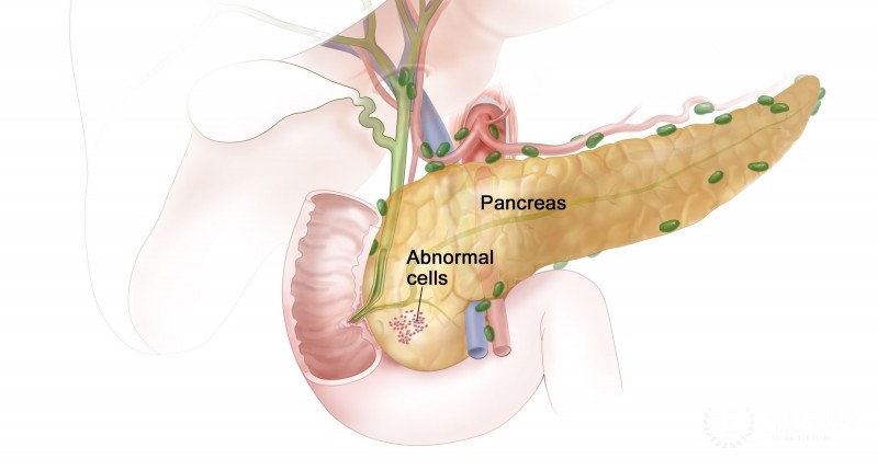 Pancreatic lesions