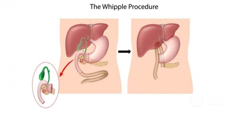 Whipple Procedure (Pancreatoduodenectomy)