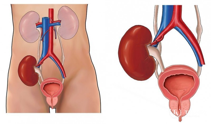 Live kidney transplantation