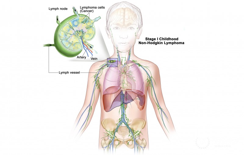 Treatment for non-Hodgkin lymphoma in adults