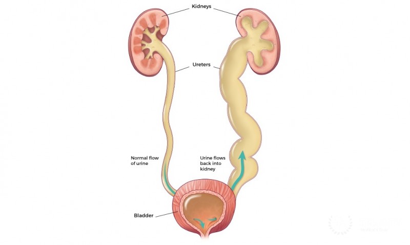 Urinary reflux