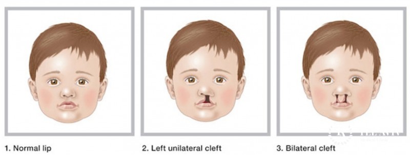 Cleft palate and lip