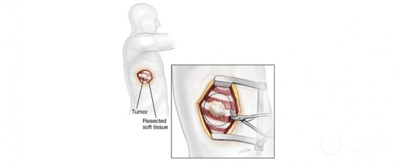 Reconstruction of the chest wall due to a congenital disability