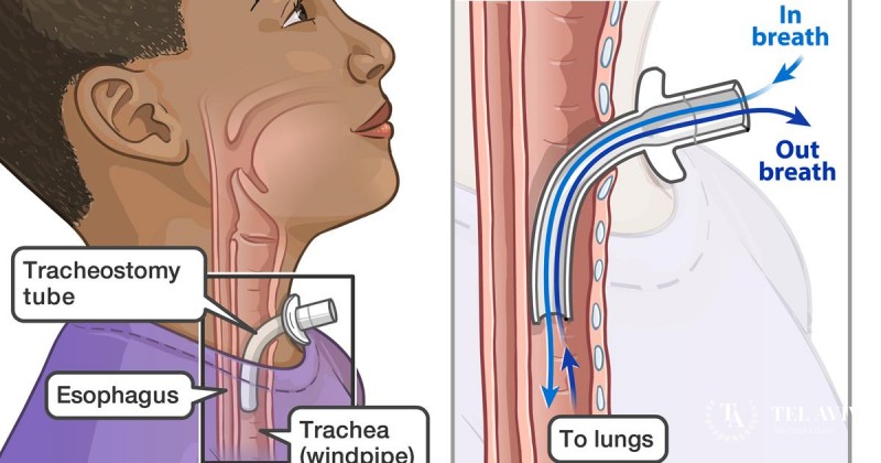 Children with tracheotomies treatment