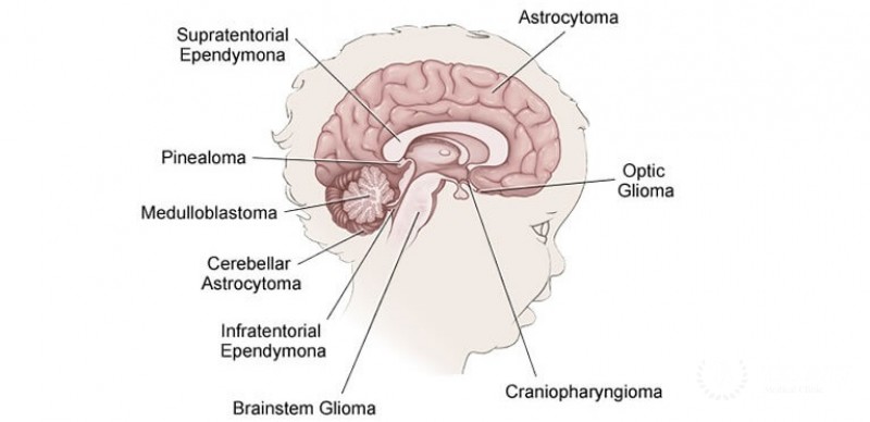 Pediatric Brain Tumor Signs & Symptoms