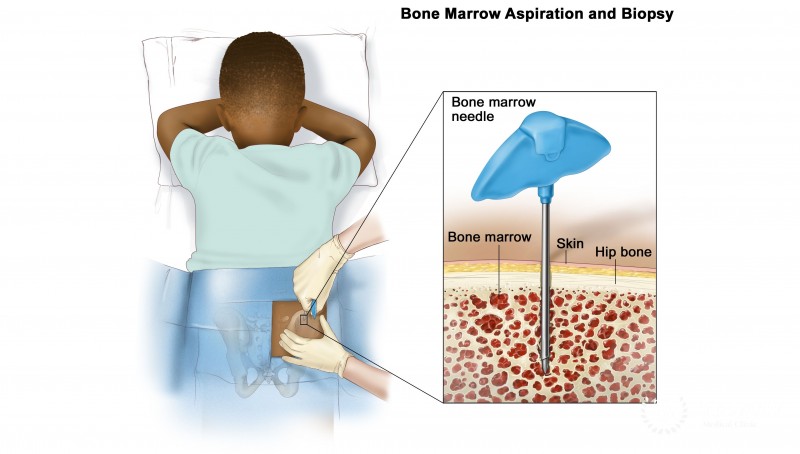 Ewing Sarcoma Diagnosis