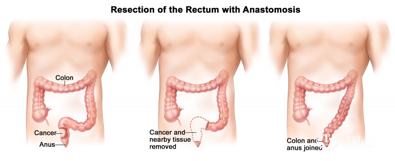 Rectal Cancer Surgery