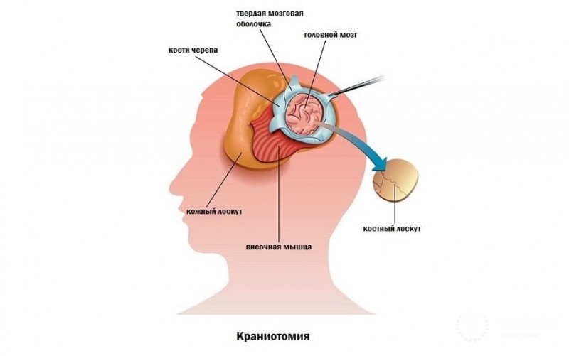 Что такое краниотомия