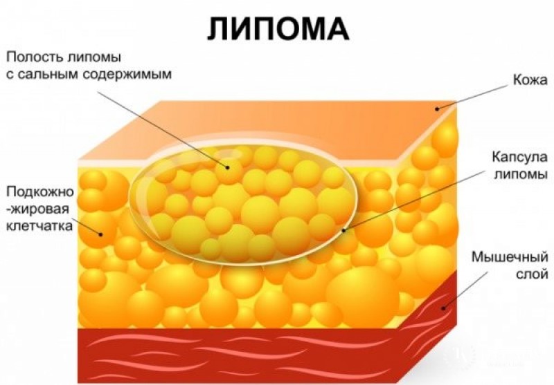 Что такое опухоли жировой ткани