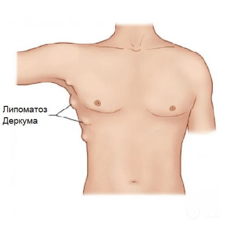 Липоматоз Деркума – симптомы, лечение