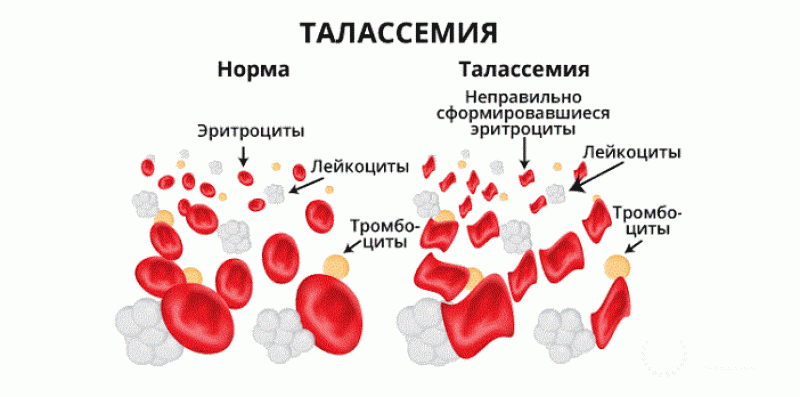 Талассемия