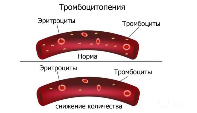 Тромбоцитопения