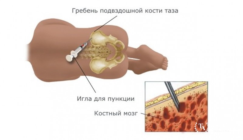 Пункция костного мозга